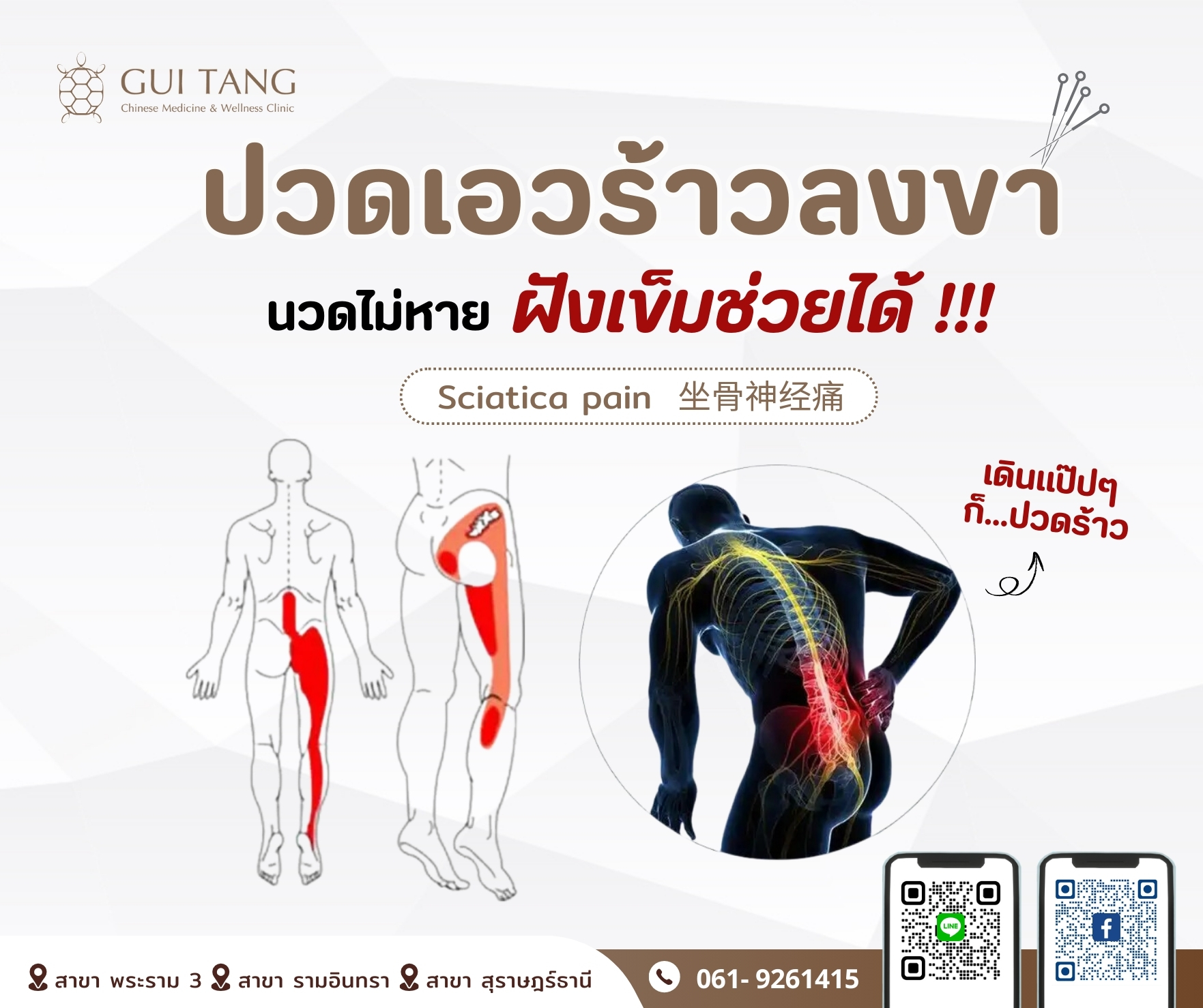ปวดเอวร้าวลงขา นวดไม่หาย...ฝังเข็มช่วยได้ !!!