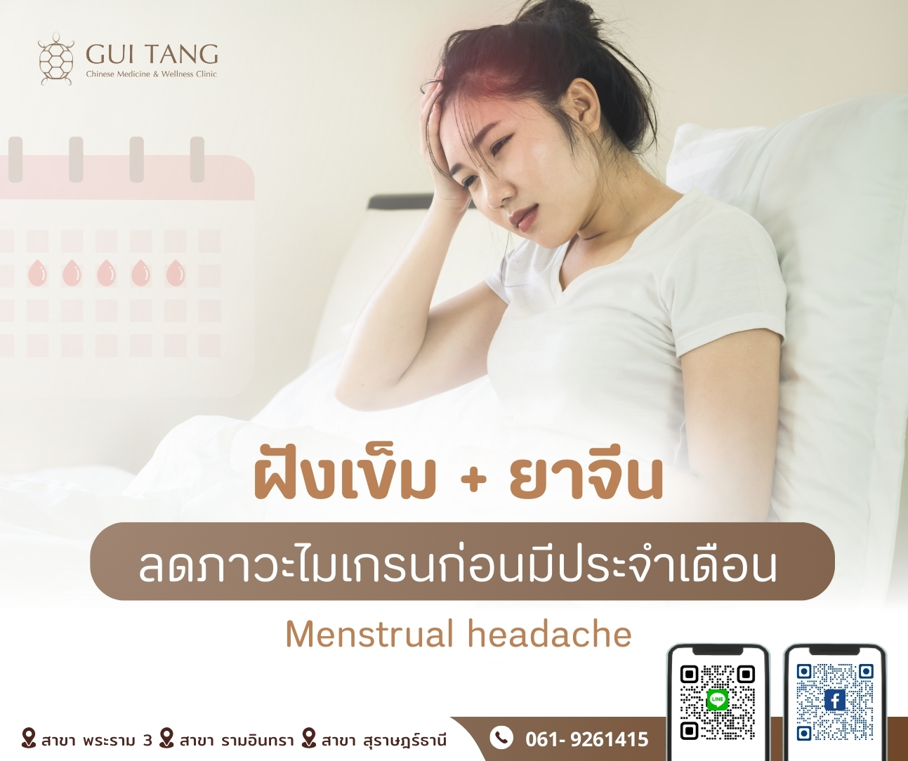 ฝังเข็ม ยาจีนลดภาวะไมเกรนก่อนมีประจำเดือน
