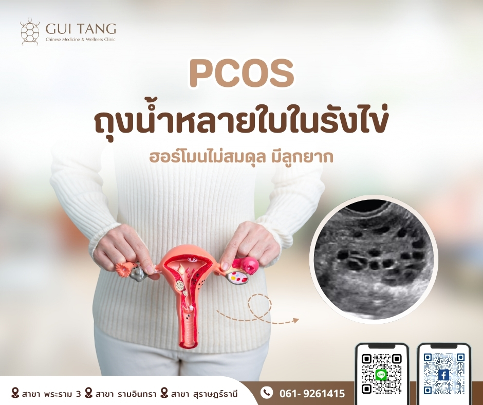  PCOS ถุงน้ำหลายใบในรังไข่ ฮอร์โมนไม่สมดุล มีลูกยาก