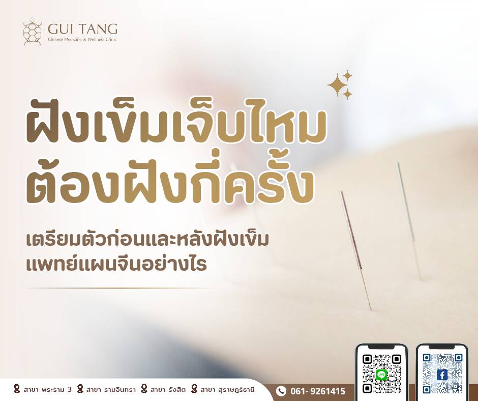 ฝังเข็มเจ็บไหม ต้องฝังกี่ครั้ง เตรียมตัวก่อนและหลังฝังเข็มแพทย์แผนจีนอย่างไร