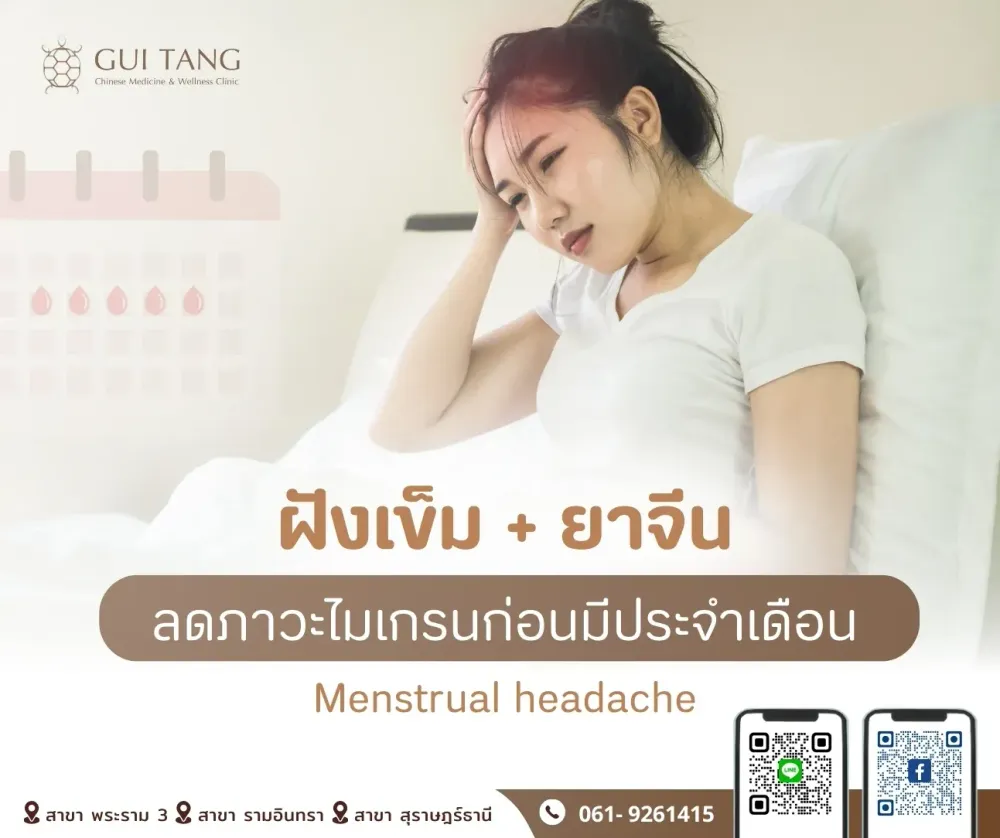 ฝังเข็ม ยาจีนลดภาวะไมเกรนก่อนมีประจำเดือน