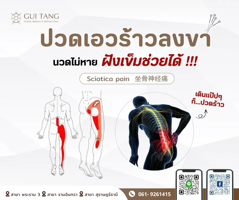 ปวดเอวร้าวลงขา นวดไม่หาย...ฝังเข็มช่วยได้ !!!
