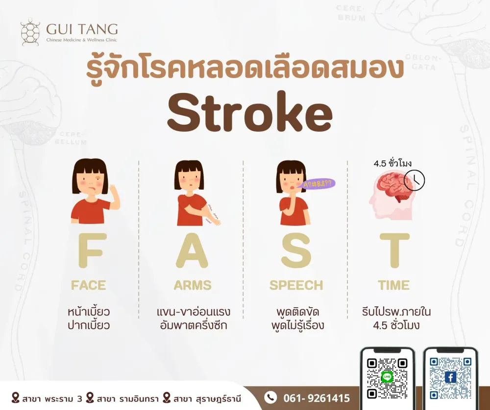 รู้จักโรคหลอดเลือดสมอง “Stroke”