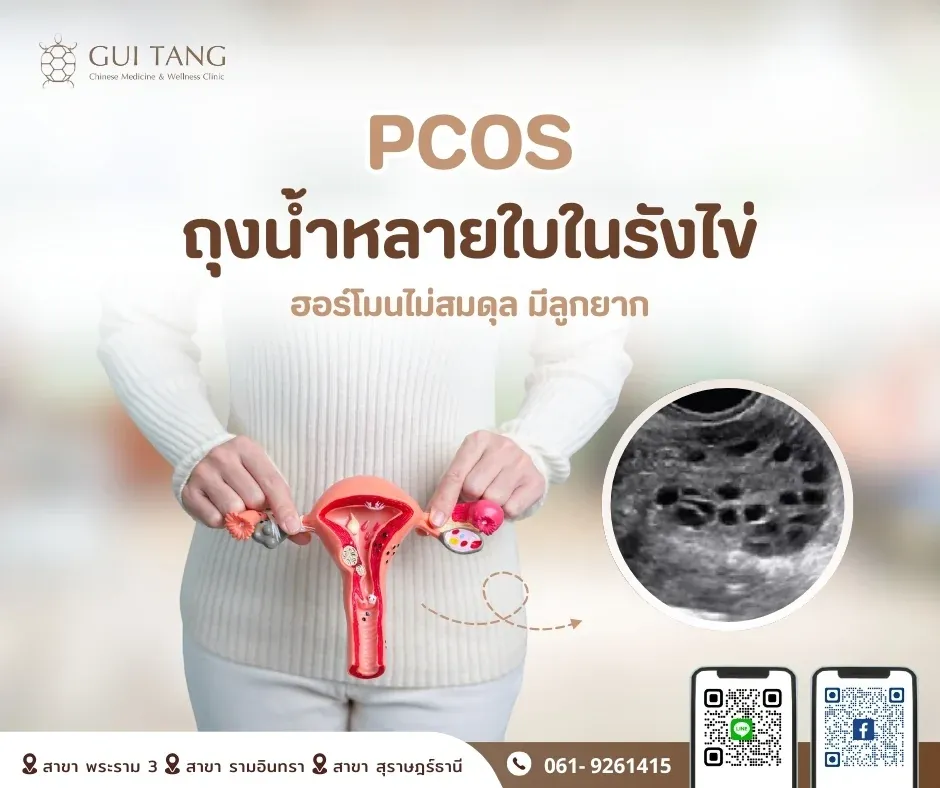 PCOS ถุงน้ำหลายใบในรังไข่ ฮอร์โมนไม่สมดุล มีลูกยาก