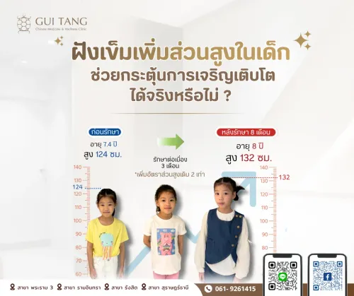 ฝังเข็มเพิ่มส่วนสูงในเด็ก ช่วยกระตุ้นการเจริญเติบโตได้จริงหรือไม่