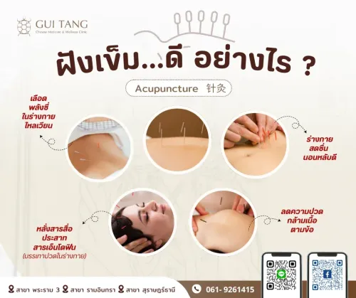 ฝังเข็ม...ดี อย่างไร ?