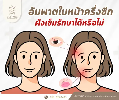 อัมพาตใบหน้า ฝังเข็มรักษาได้หรือไม่