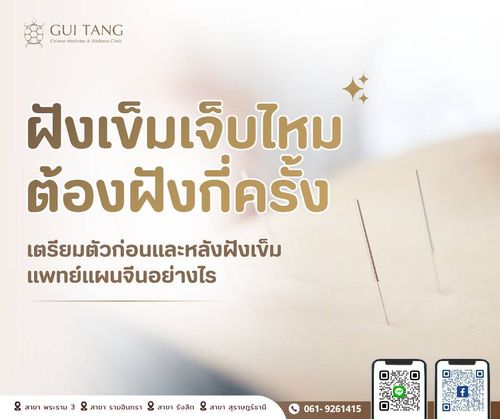 ฝังเข็มเจ็บไหม ต้องฝังกี่ครั้ง เตรียมตัวก่อนและหลังฝังเข็มแพทย์แผนจีนอย่างไร