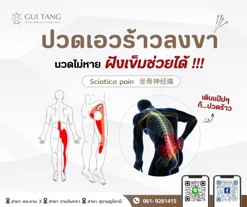 ปวดเอวร้าวลงขา นวดไม่หาย...ฝังเข็มช่วยได้ !!!