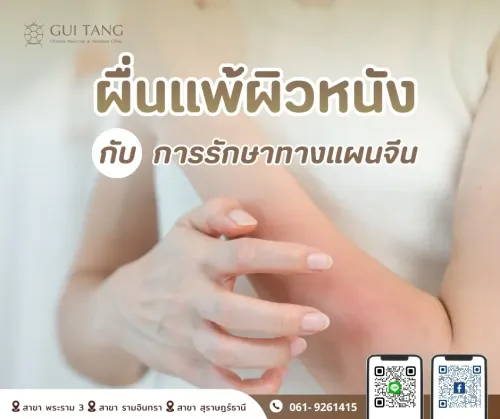 ผื่นแพ้ผิวหนังกับการรักษาทางแผนจีน