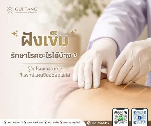 ฝังเข็มรักษาโรคอะไรได้บ้าง? รู้จักโรคและอาการที่แพทย์แผนจีนช่วยดูแลได้ — กุยถัง เวลเนส