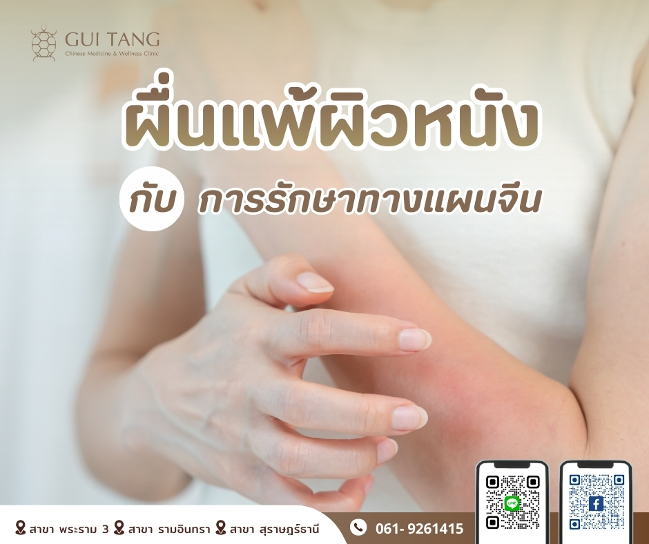 ผื่นแพ้ผิวหนังกับการรักษาทางแผนจีน