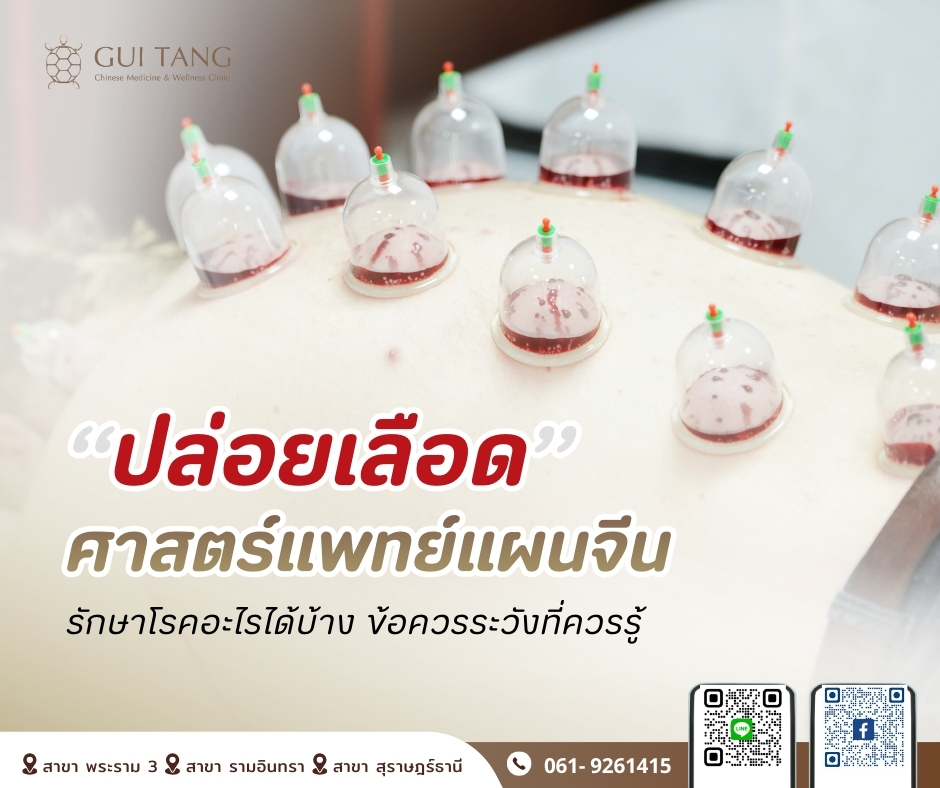 “ปล่อยเลือด” ศาสตร์แพทย์แผนจีน   รักษาโรคอะไรได้บ้าง และ ข้อควรระวังที่ควรรู้