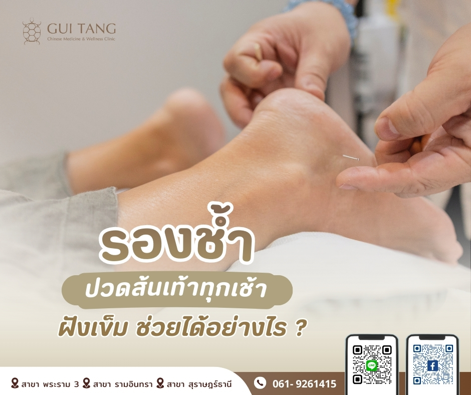 “รองช้ำ” ปวดส้นเท้าทุกเช้า ฝังเข็มช่วยได้อย่างไร ?
