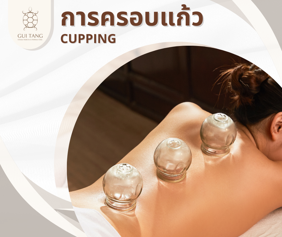 การครอบแก้ว CUPPING THERAPY