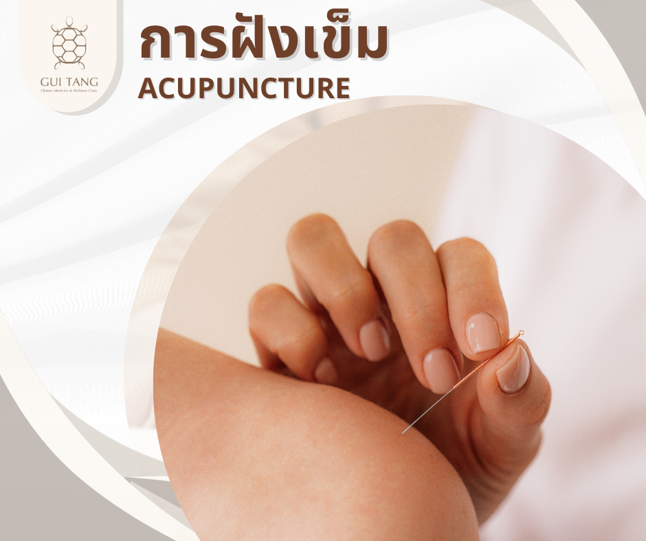 การฝังเข็ม ACUPUNCTURE